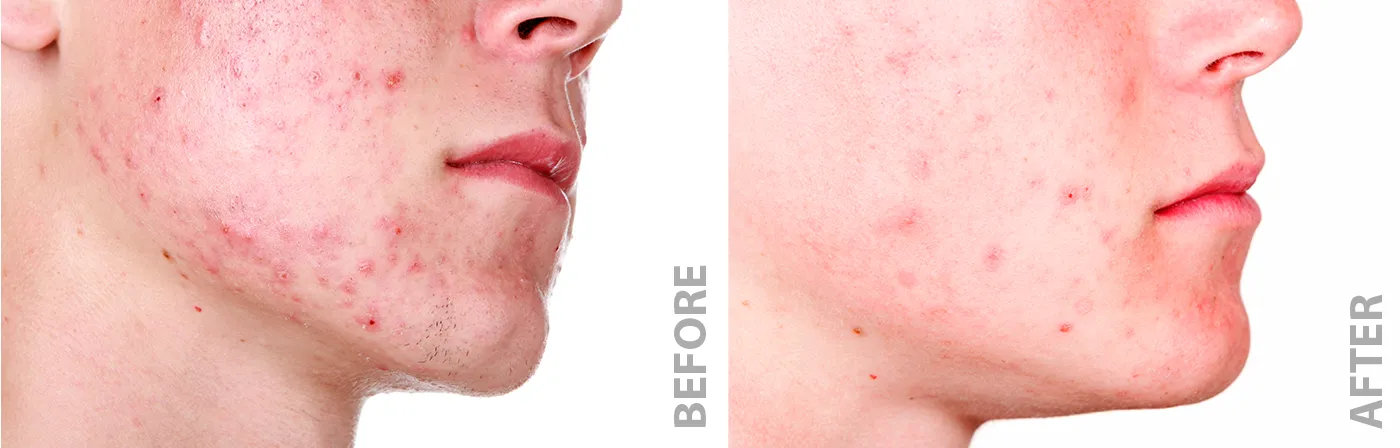 Before and after four microdermabrasions and four Celluma treatments
