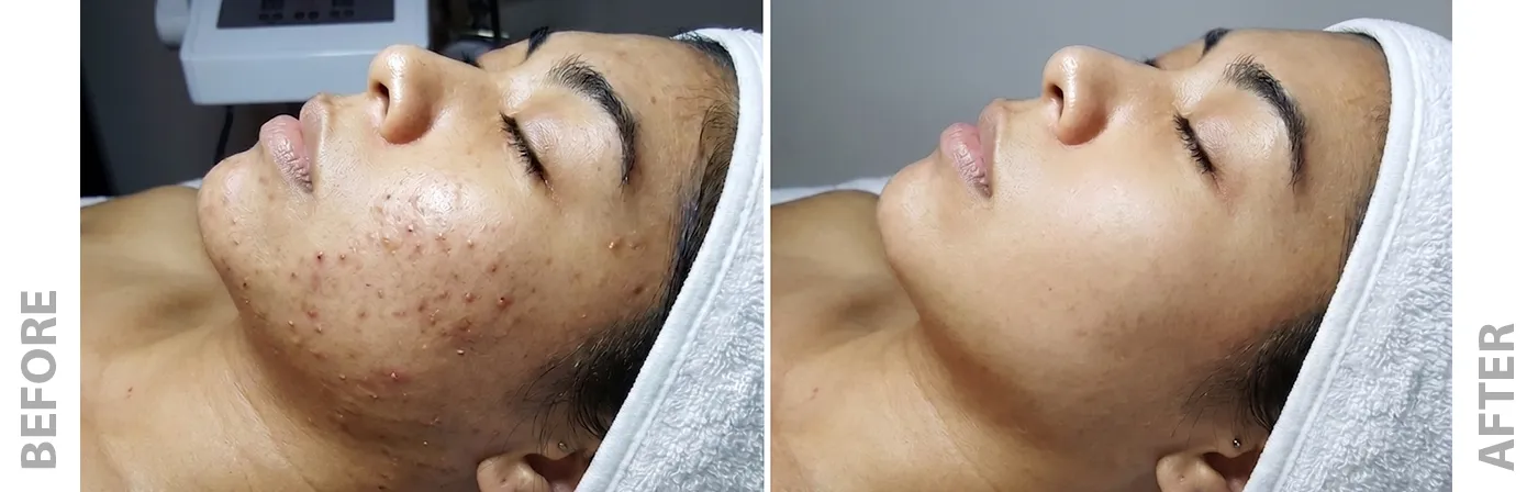 Before and after acne treatment, six months post-treatment